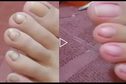 INGROWN REMOVAL PEDICURE CLEANING PAOLA /SATISFYING CLIENT72 @Che che Legario