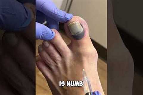 Ouch! Numbing A Toe: A Quick Fix