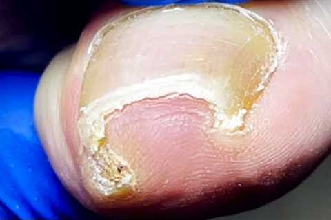 Super Curly Ingrown Nails, Silky Trimming~【Pedicure Master Lin Jun】