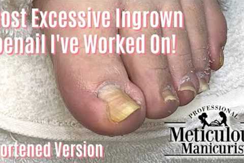 Most Extreme Ingrown Toenail Salon Pedicure - Shortened