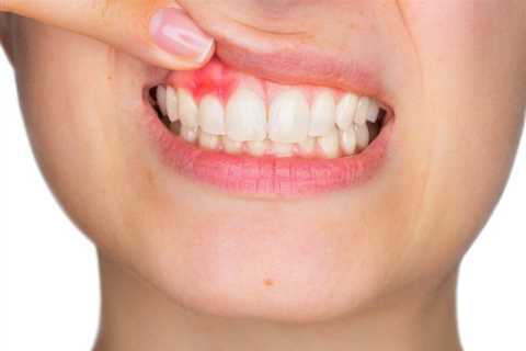 Gum Recession Grow Back? Proven Treatments - Teeth for Better Health